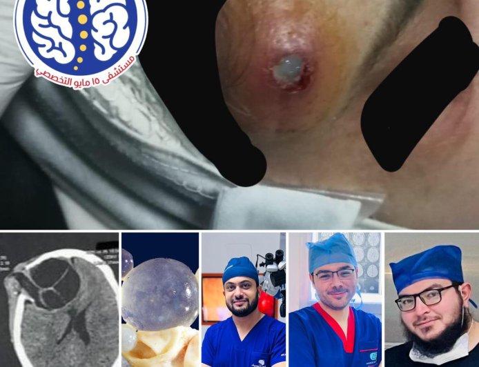 الصداع المزمن إلى الجراحة المنقذة للحياة : قصة انتصار الطب على كيس مائي بالمخ بفضل الله