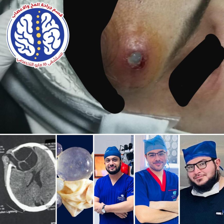 الصداع المزمن إلى الجراحة المنقذة للحياة : قصة انتصار الطب على كيس مائي بالمخ بفضل الله