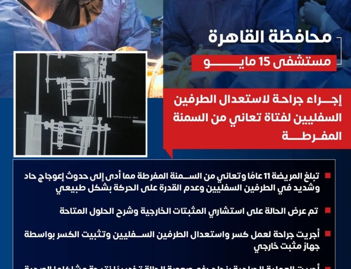 " مستشفى ١٥ مايو  النموذجي " تتصدى المركز الأول بمجهودات فريق و جراحات العظام المتقدمة إنقاذ فتاة تبلغ من العمر 11 عاما تعانى من السمنه المفرطه