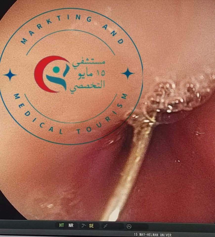 " مستشفى ١٥ مايو " نجاح فريق الجهاز الهضمي في استخراج جسم معدني من معدة فتاة باستخدام المنظار