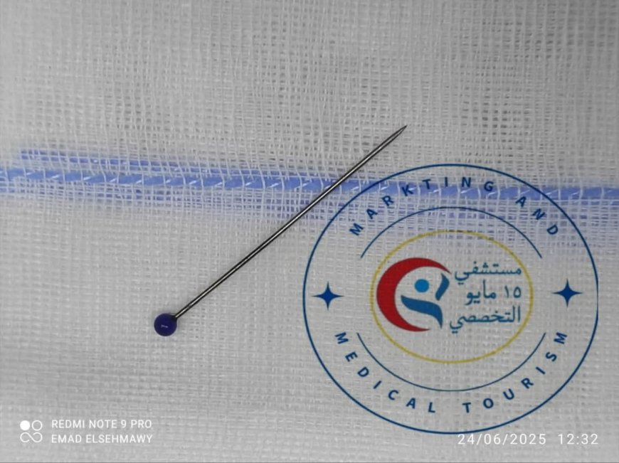 " مستشفى ١٥ مايو " نجاح فريق الجهاز الهضمي في استخراج جسم معدني من معدة فتاة باستخدام المنظار