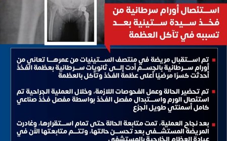 مستشفى ١٥ مايو " نجاح جديد بوحدة جراحات الأورام استئصال أورام سرطانية من فخذ سيدة ستينية بعد تسببه في تأكل العظمة
