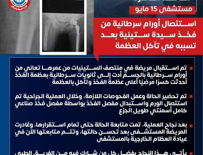 مستشفى ١٥ مايو " نجاح جديد بوحدة جراحات الأورام استئصال أورام سرطانية من فخذ سيدة ستينية بعد تسببه في تأكل العظمة