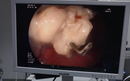 " مستشفى ١٥ مايو  النموذجي " تتصدى المركز الأول ديما بمجهودات فريق الجهاز الهضمي  استخراج جسم معدني من طفل لإنقاذ حياه
