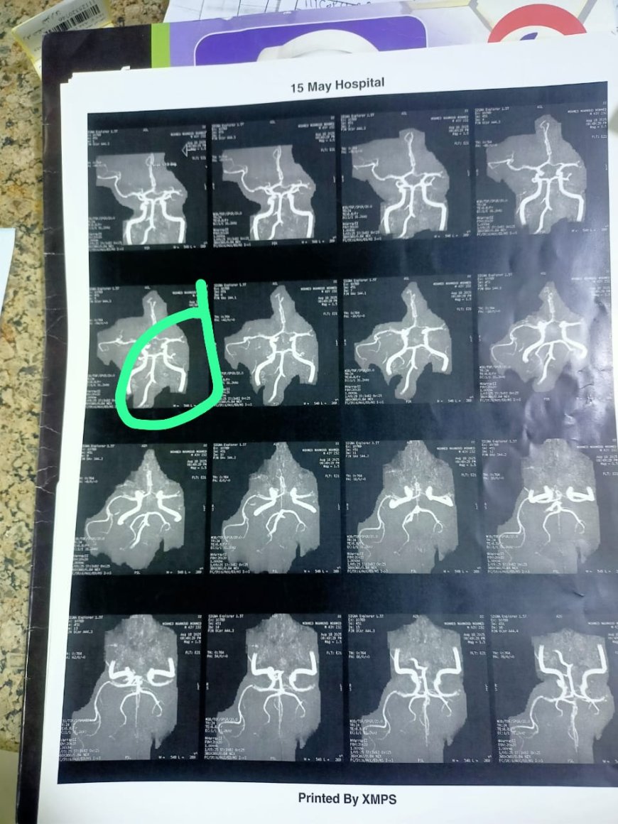 " أمانة المراكز الطبية المتخصصة " تنجح في تقديم انجاز جديدة بوحده السكته الدماغيه بمستشفي ١٥ مايو