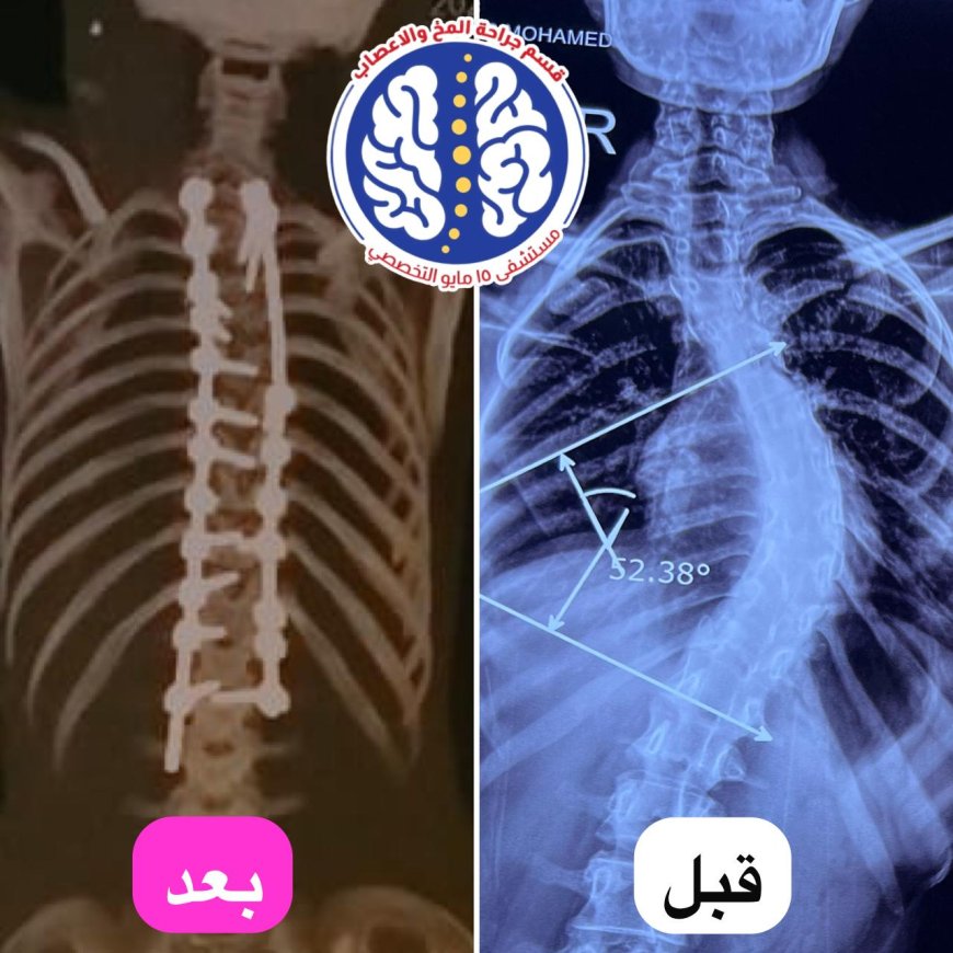 " مستشفى ١٥ مايو  النموذجي " تتصدى المركز الأول  بمجهودات إنجاز طبي جديد في جراحة العمود الفقري