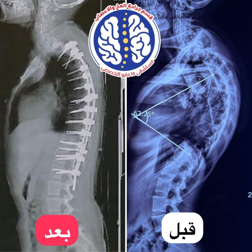 " مستشفى ١٥ مايو  النموذجي " تتصدى المركز الأول  بمجهودات إنجاز طبي جديد في جراحة العمود الفقري
