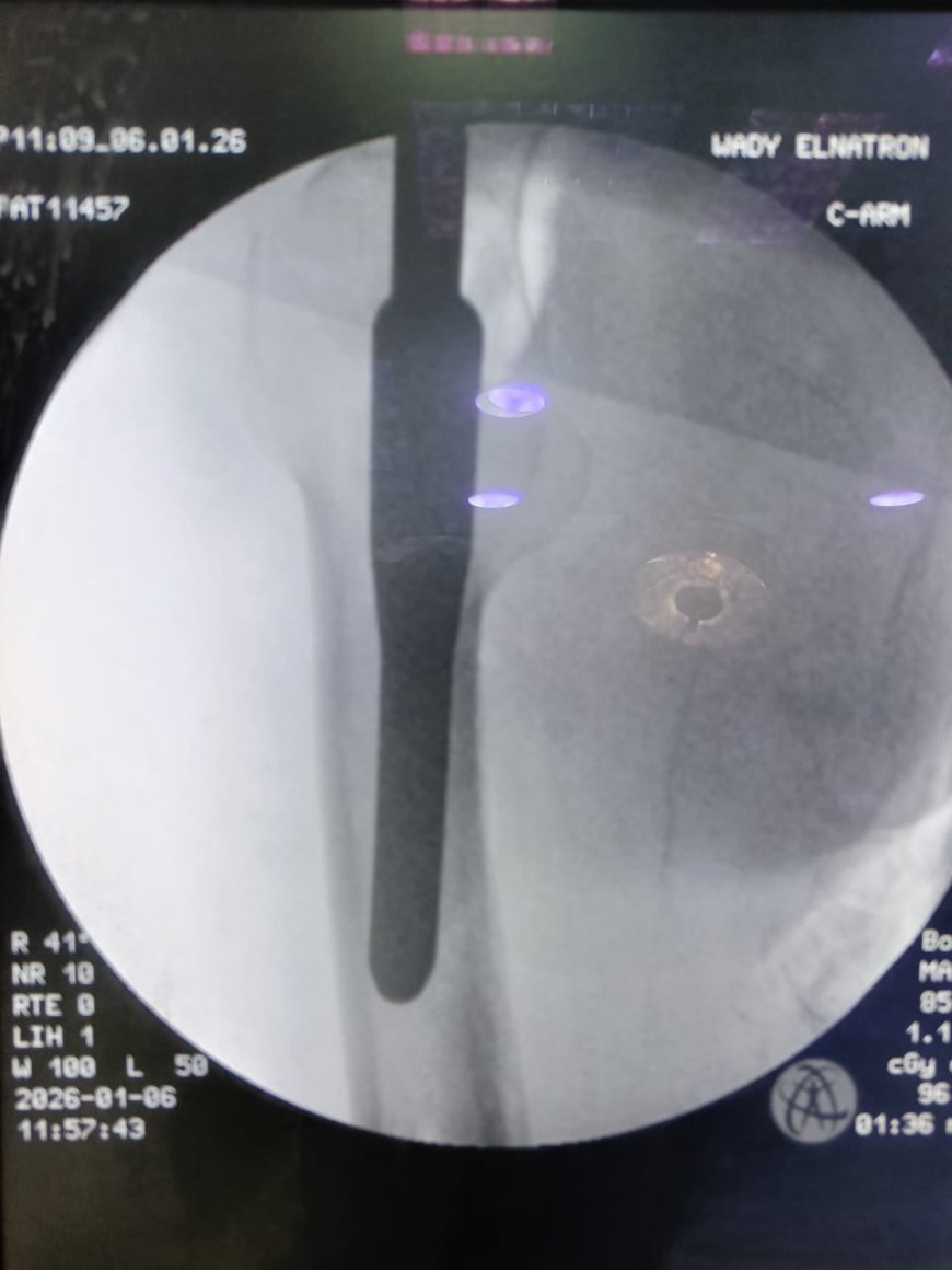 تدخل جراحي عاجل ينقذ مريض فشل كلوي من مضاعفات كسر أعلى الفخذ بمستشفى وادي النطرون التخصصي