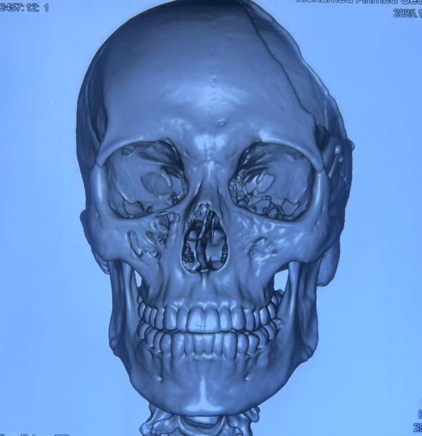 وزارة الصحة تعلن نجاح جراحة دقيقة لترقيع عظام الجمجمة بمستشفى 15 مايو النموذجي