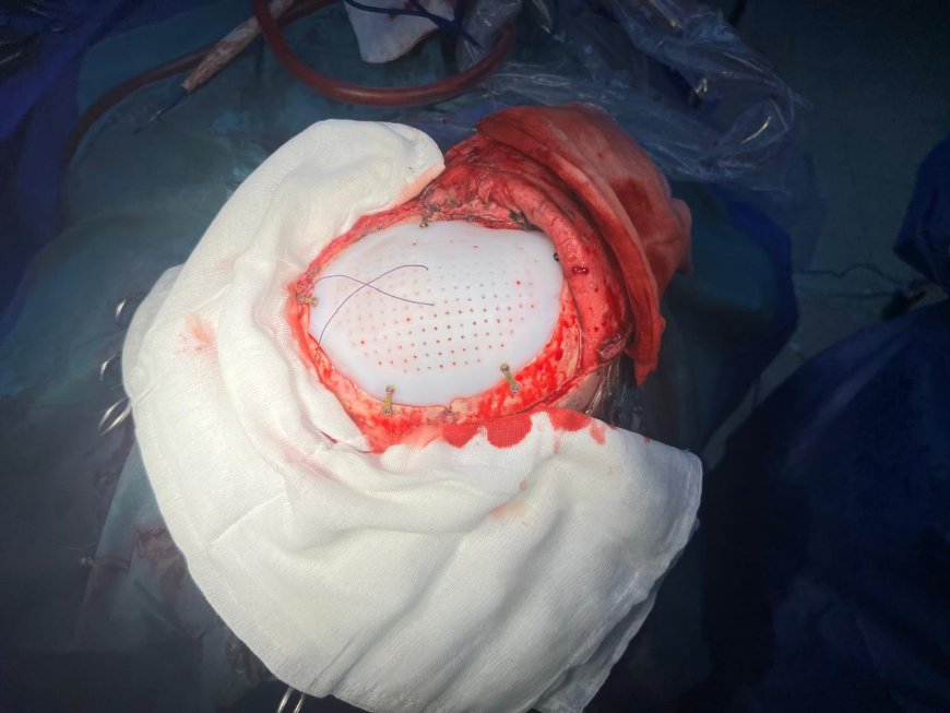 وزارة الصحة تعلن نجاح جراحة دقيقة لترقيع عظام الجمجمة بمستشفى 15 مايو النموذجي