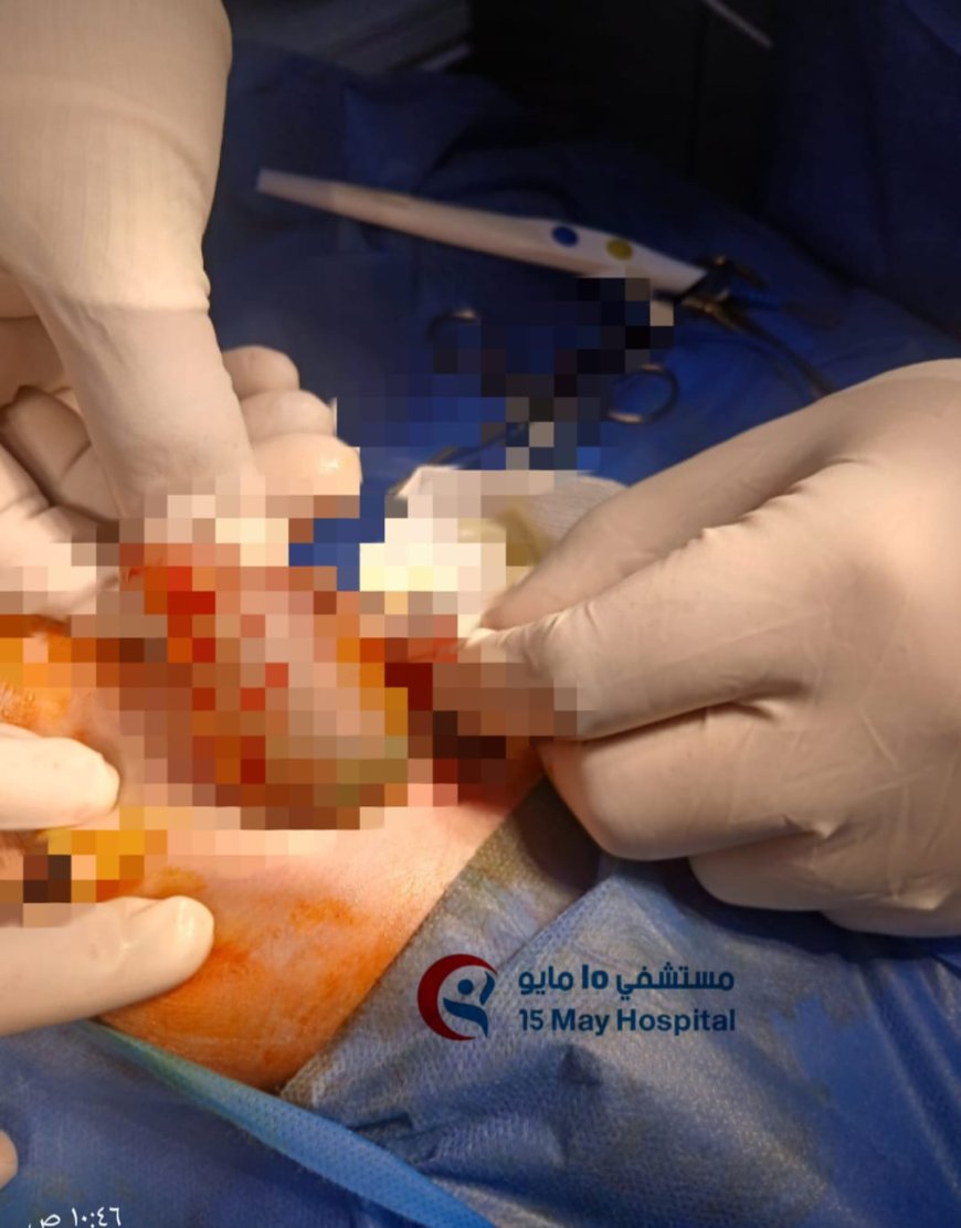 نجاح أول تدخل طبي دقيق لمولود حديث الولادة بمستشفى 15 مايو التخصصي