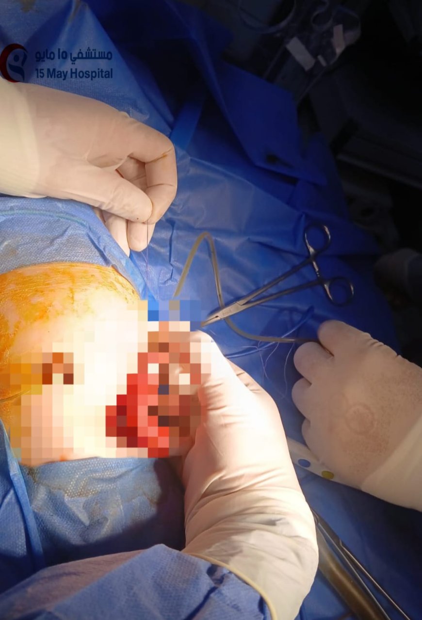نجاح أول تدخل طبي دقيق لمولود حديث الولادة بمستشفى 15 مايو التخصصي