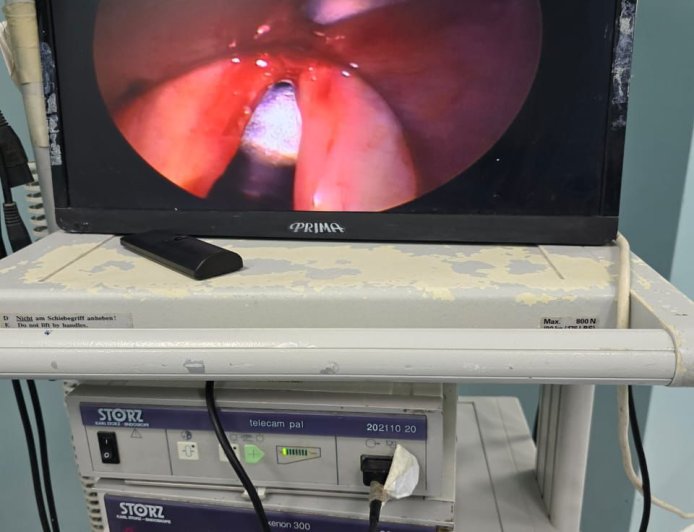 نجاح مستشفى منشية البكري العام في إجراء جراحة دقيقة لاستئصال لحمية بالأحبال الصوتية