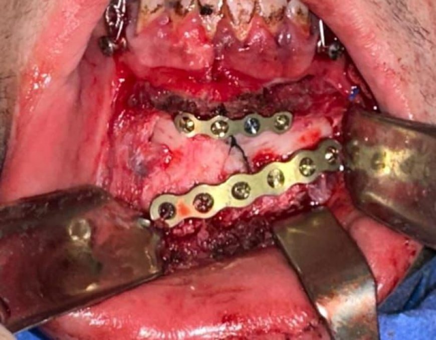 عيادات الأسنان تقدم خدماتها لـ428 مريضًا خلال عيد الفطر المبارك.. ونجاح جراحة وجه وفكين عاجلة بمستشفى عين شمس العام