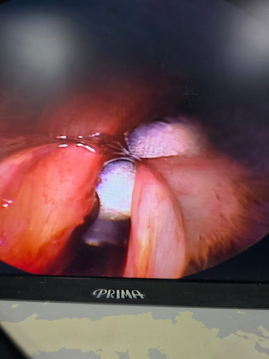 نجاح مستشفى منشية البكري العام في إجراء جراحة دقيقة لاستئصال لحمية بالأحبال الصوتية