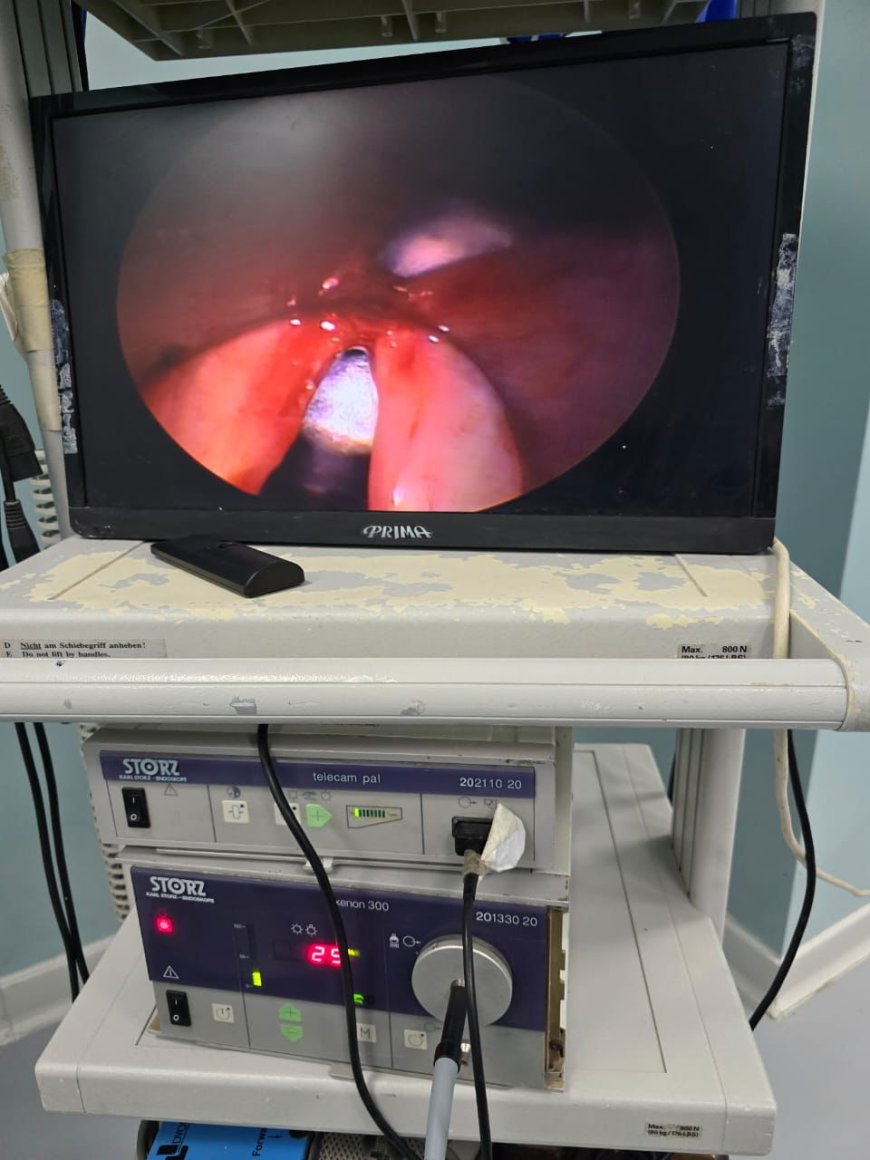 نجاح مستشفى منشية البكري العام في إجراء جراحة دقيقة لاستئصال لحمية بالأحبال الصوتية