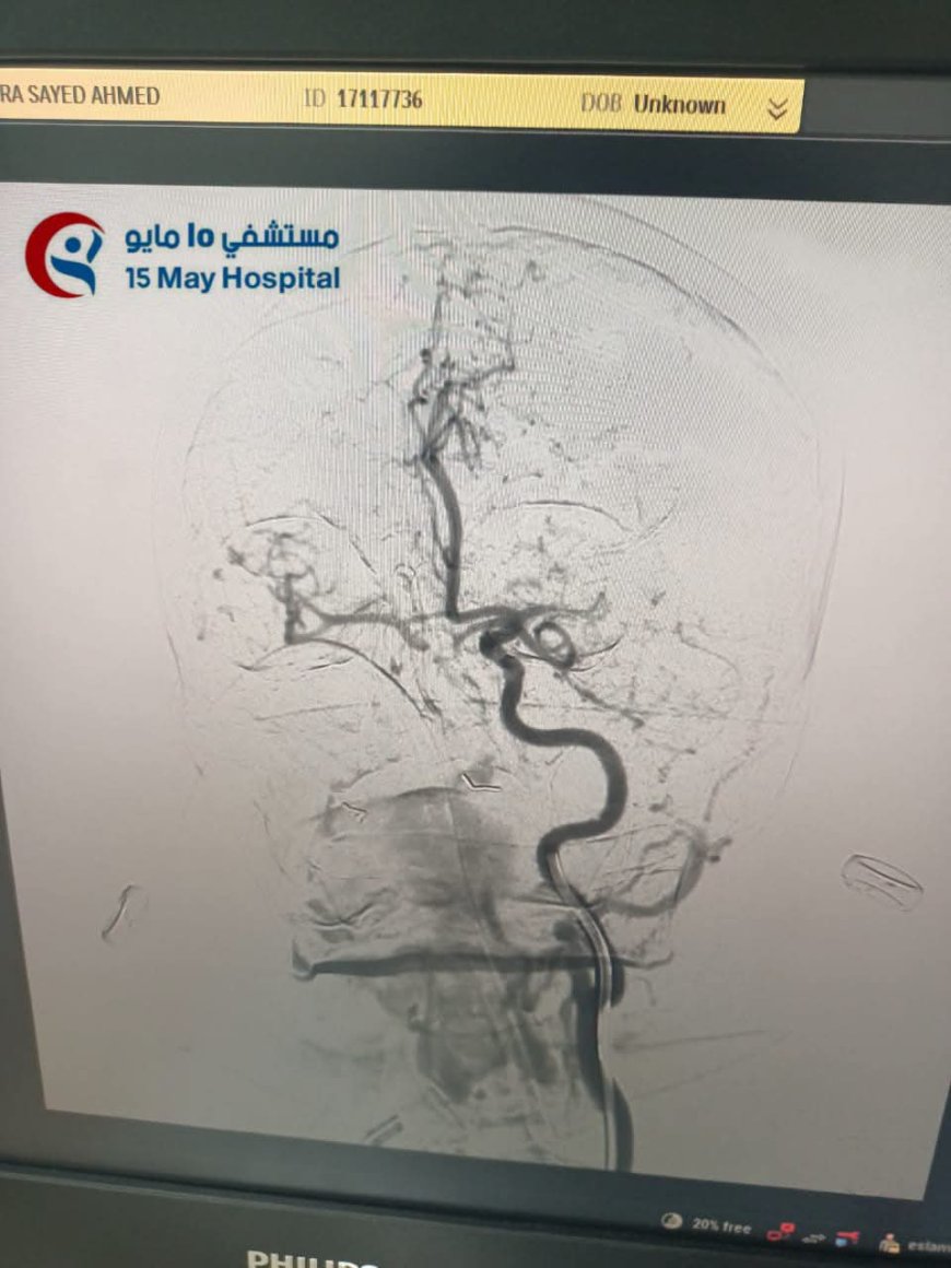 نجاح جديد يرسخ مكانة مستشفى 15 مايو التخصصي في علاج السكتات الدماغية بأحدث تقنيات القسطرة المخية